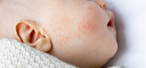 L’acné de bébé expliqué