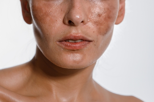 Gérer l’hyperpigmentation associée au SOPK : approches médicales et soins de la peau