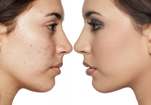 L’acné et le maquillage : quelles sont les précautions à prendre ?