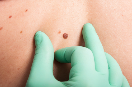 Liens entre grains de beauté et cancer de la peau : à savoir