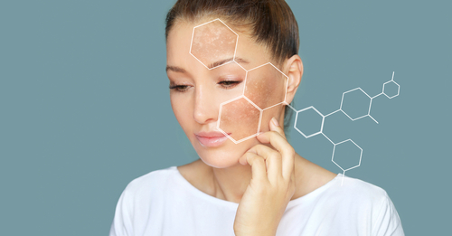 Traitements physiques pour atténuer l’hyperpigmentation dans le SOPK