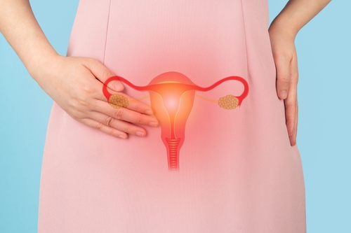 Faire la différence : ovaires multifolliculaires et syndrome des ovaires polykystiques (SOPK)