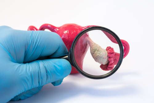 Types de kystes ovariens : quels sont-ils et comment les différencier ?